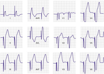 correct pacemaker EKG